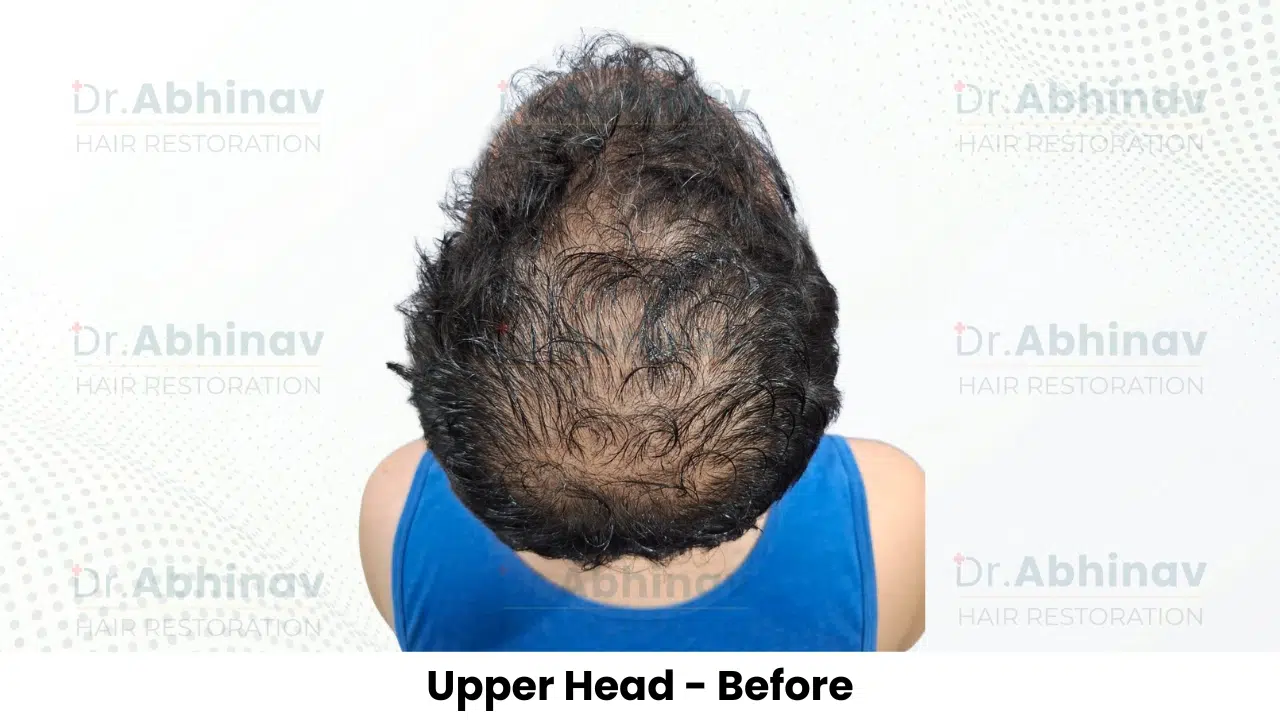 Anthony Truffer Hair Transplant Upper Head View Before - Patna