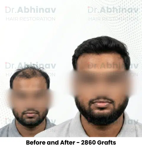 Fateullah Ansari Hair Transplant Before and After Result - Patna