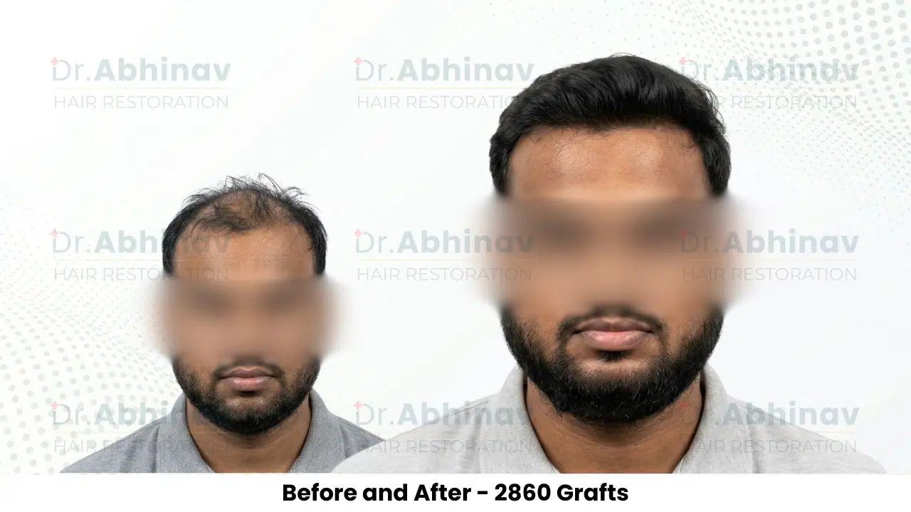 Fateullah Ansari Hair Transplant Before and After Result - Patna