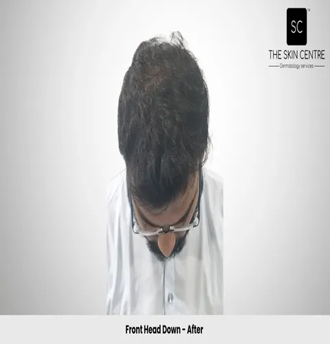 Fateullah Ansari Hair Transplant Front Head Down View After - Patna