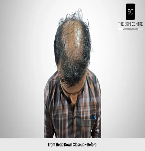 Fateullah Ansari Hair Transplant Front Head Down View Before Closeup - Patna