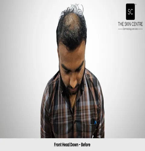 Fateullah Ansari Hair Transplant Front Head Down View Before - Patna
