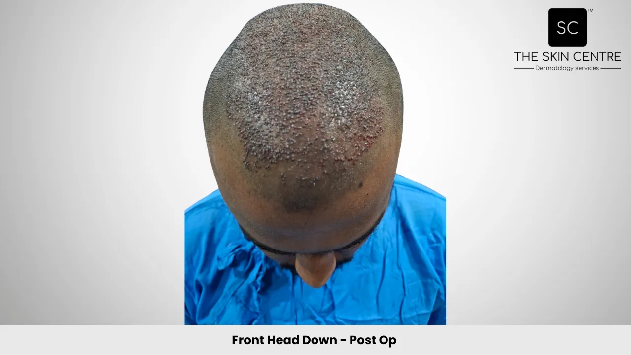 Fateullah Ansari Hair Transplant Front Head Down View Post Op - Patna