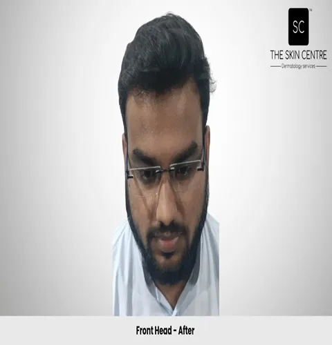 Fateullah Ansari Hair Transplant Front View After - Patna