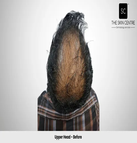 Fateullah Ansari Hair Transplant Upper Head View Before - Patna