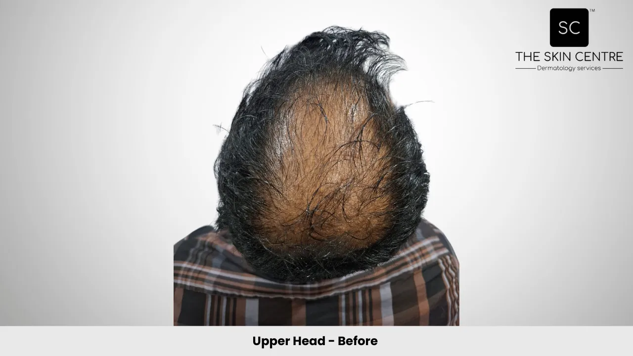 Fateullah Ansari Hair Transplant Upper Head View Before - Patna