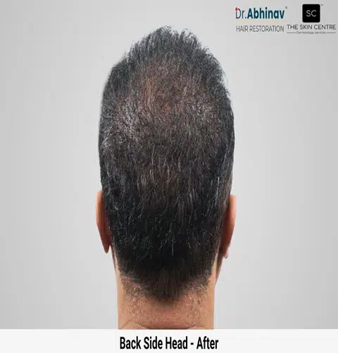Prateek Hair Transplant Back Side Head View After - Patna