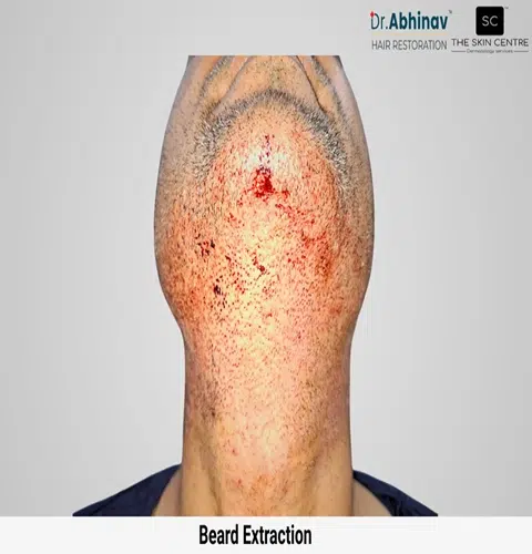 Prateek Hair Transplant Beard Extraction View Post Op - Patna
