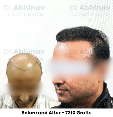 Prateek Hair Transplant Before and After Result - Patna