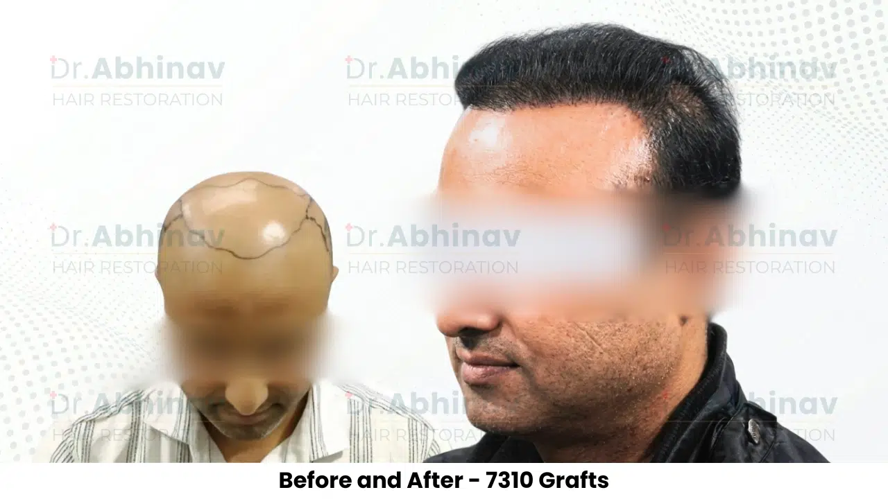 Prateek Hair Transplant Before and After Result - Patna
