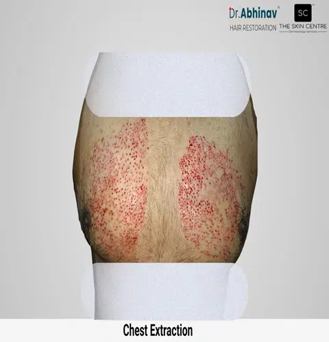Prateek Hair Transplant Chest Extraction View Post Op - Patna