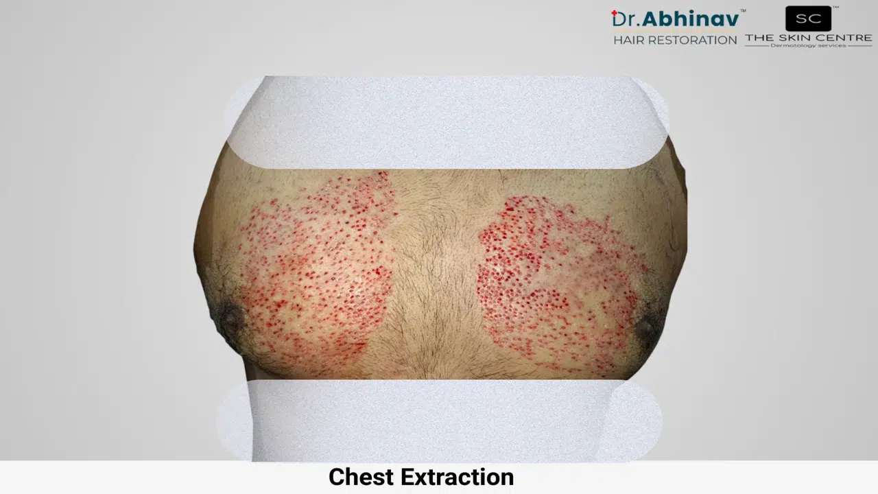 Prateek Hair Transplant Chest Extraction View Post Op - Patna