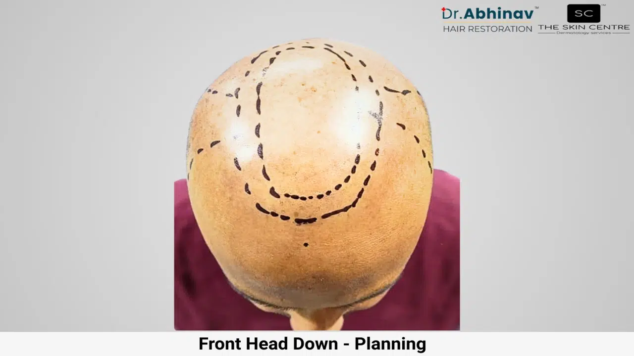 Prateek Hair Transplant Front Head Down View Planning - Patna