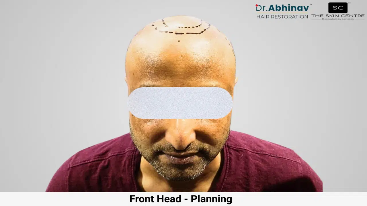 Prateek Hair Transplant Front Head View Planning - Patna