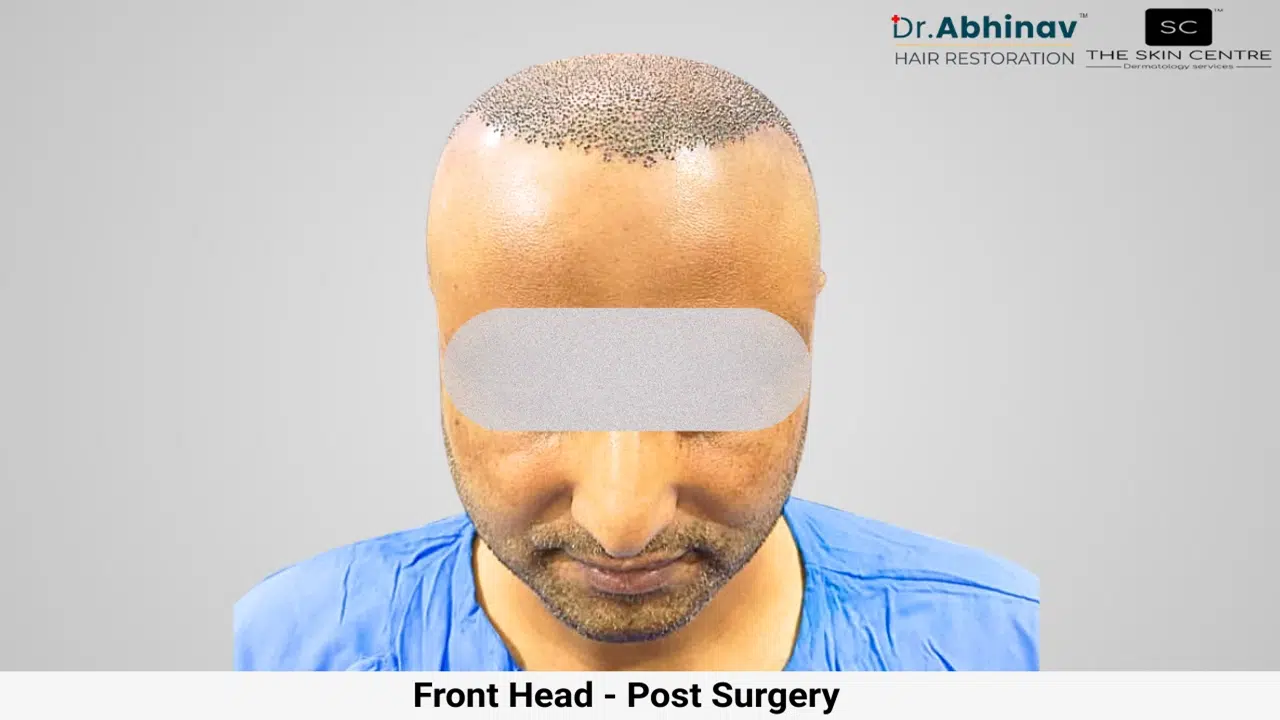 Prateek Hair Transplant Front Head View Post Op - Patna