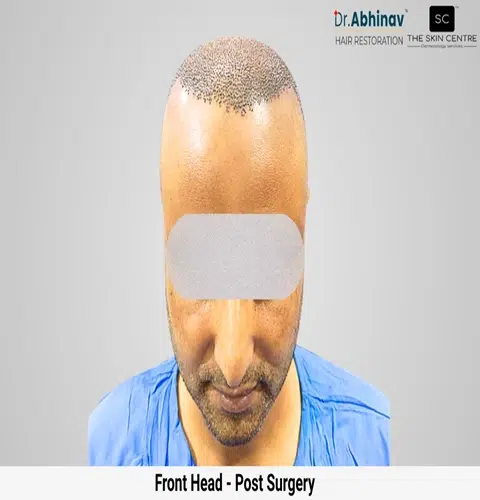Prateek Hair Transplant Front Head View Post Op - Patna