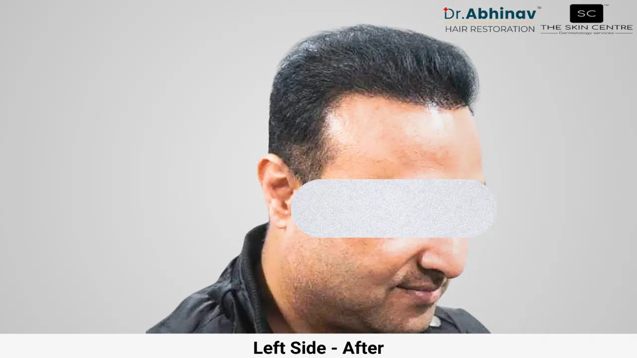 Prateek Hair Transplant Left Side View After - Patna