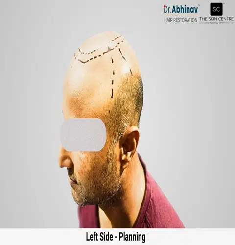Prateek Hair Transplant Left Side View Planning - Patna