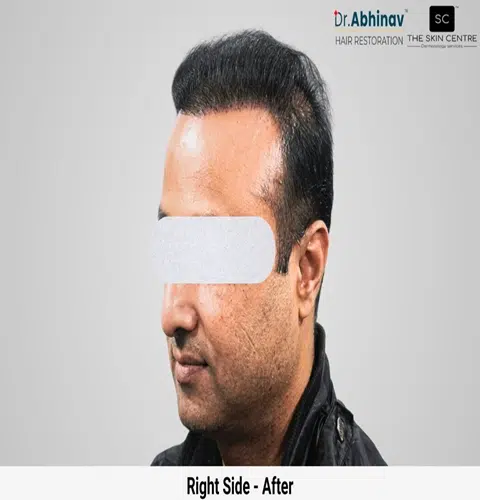 Prateek Hair Transplant Right Side View After - Patna