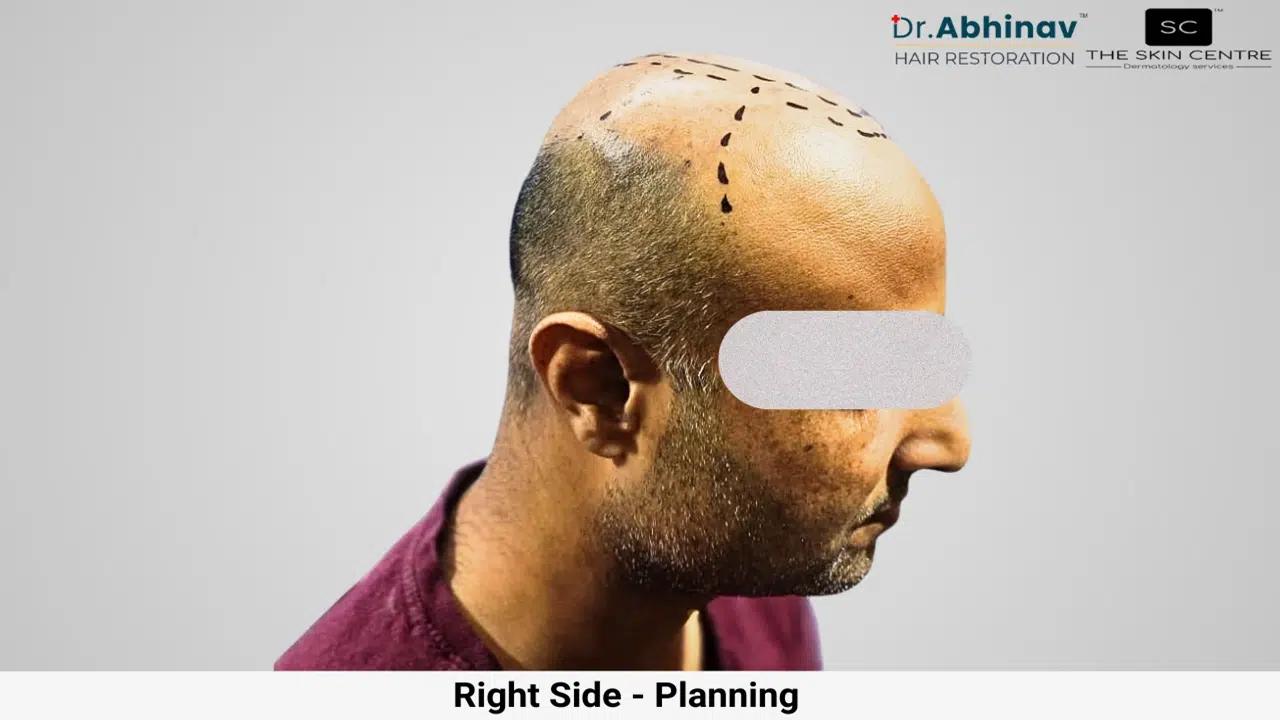 Prateek Hair Transplant Right Side View Planning - Patna