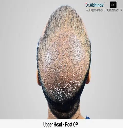 Prateek Hair Transplant Upper Head View Post Op - Patna