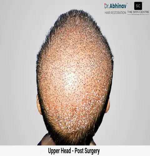Prateek Hair Transplant Upper Head View Post Op - Patna Prateek Hair Transplant Upper Head View Post Surgery - Patna