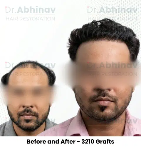 Rajan Kumar Hair Transplant Before and After Result - Patna