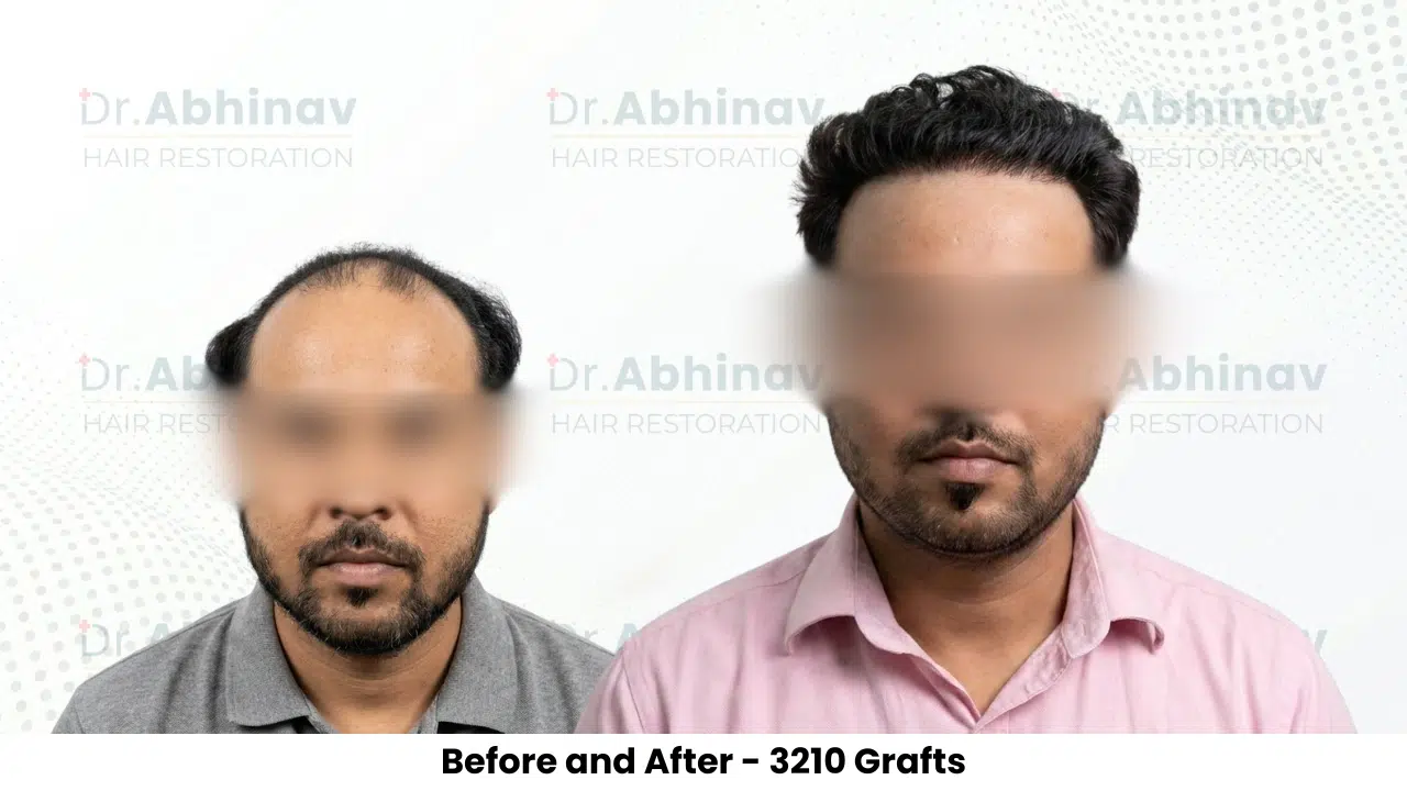Rajan Kumar Hair Transplant Before and After Result - Patna