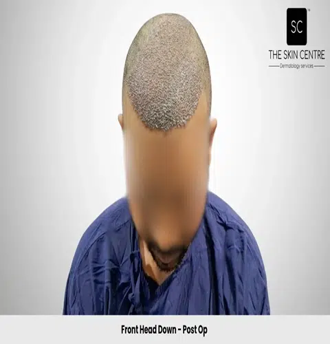 Rajan Kumar Hair Transplant Front Head Down View Post Op - Patna