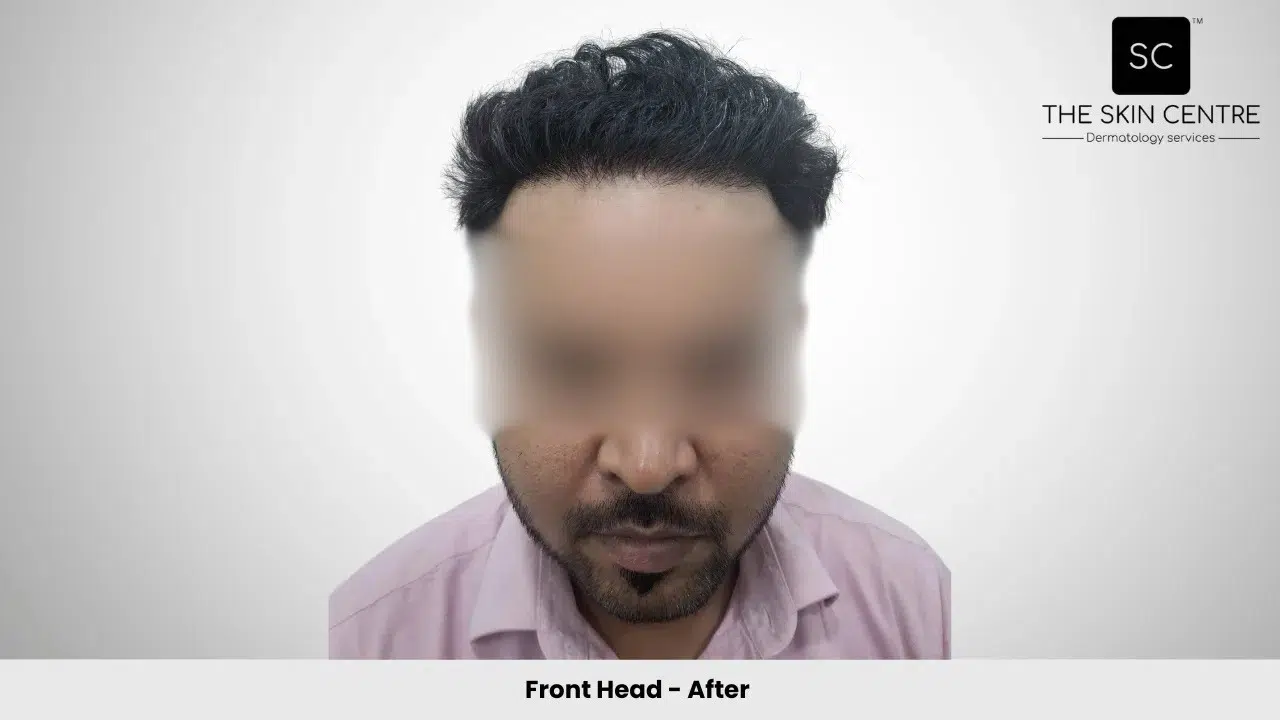 Rajan Kumar Hair Transplant Front View After - Patna