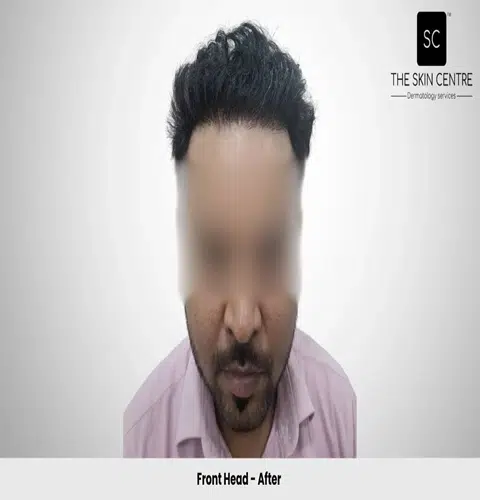 Rajan Kumar Hair Transplant Front View After - Patna
