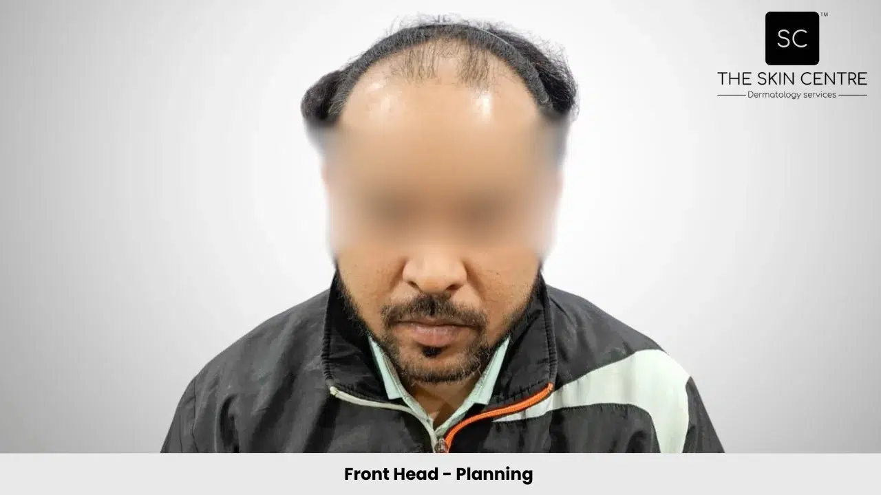 Rajan Kumar Hair Transplant Front View Planning - Patna