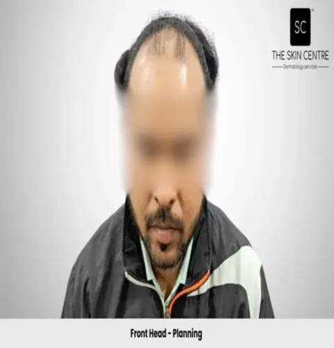 Rajan Kumar Hair Transplant Front View Planning - Patna