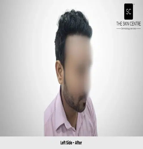 Rajan Kumar Hair Transplant Left View After - Patna