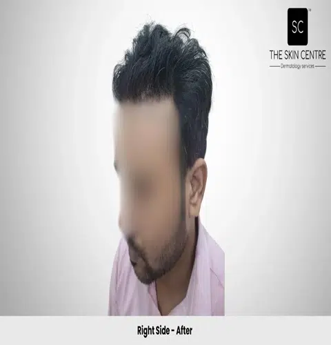 Rajan Kumar Hair Transplant Right View After - Patna