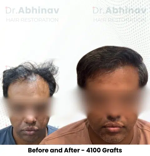 Shreyas Hair Transplant Before and After Result - Patna