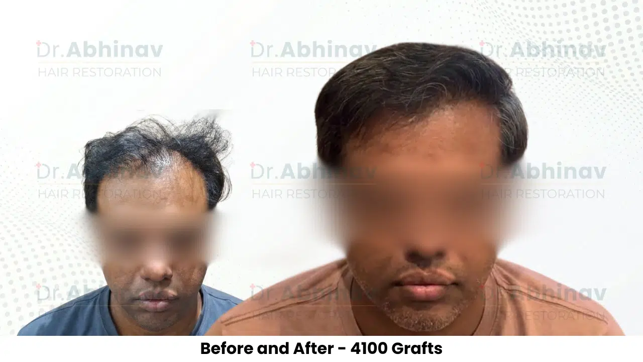 Shreyas Hair Transplant Before and After Result - Patna