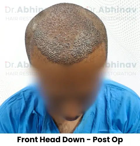 Shreyas Hair Transplant Front Head Down View Post Op - Patna