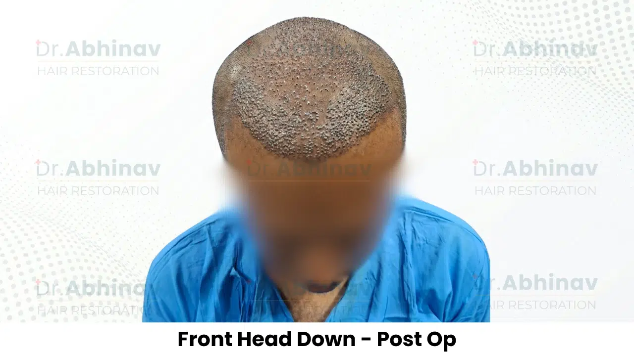 Shreyas Hair Transplant Front Head Down View Post Op - Patna
