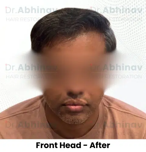 Shreyas Hair Transplant Front Head View After - Patna
