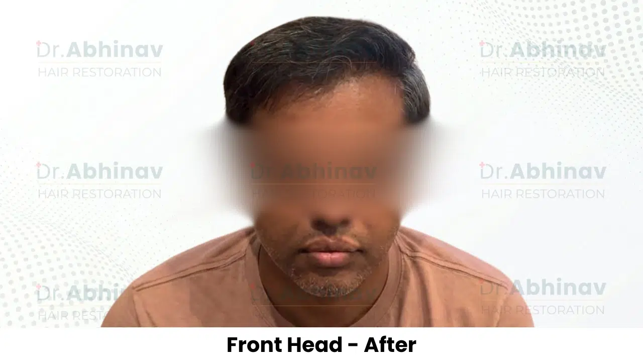 Shreyas Hair Transplant Front Head View After - Patna