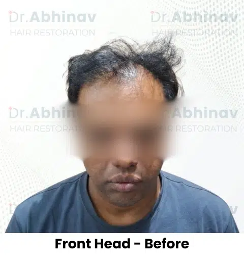 Shreyas Hair Transplant Front Head View Before - Patna