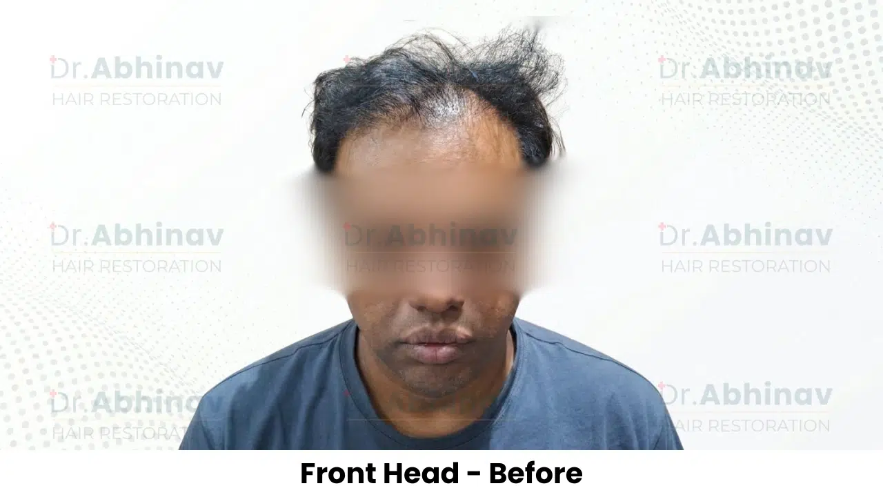Shreyas Hair Transplant Front Head View Before - Patna
