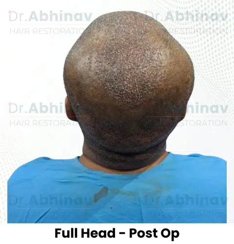 Shreyas Hair Transplant Full Head View Post Op - Patna