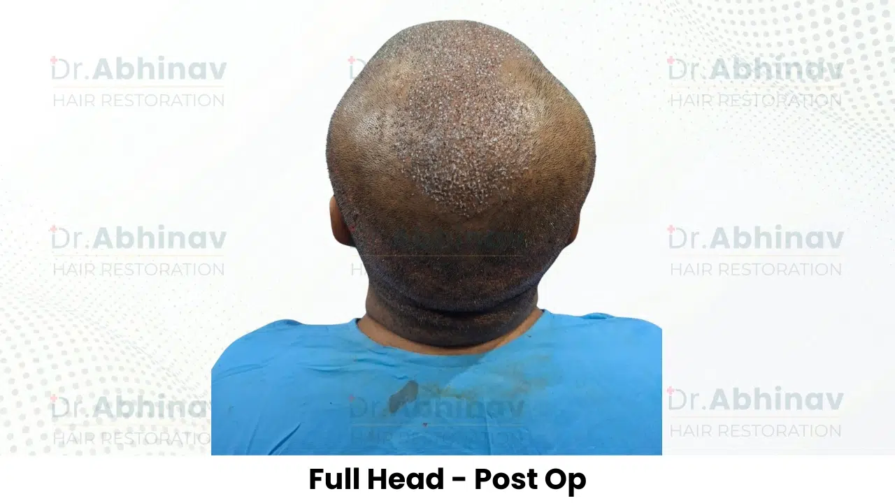 Shreyas Hair Transplant Full Head View Post Op - Patna