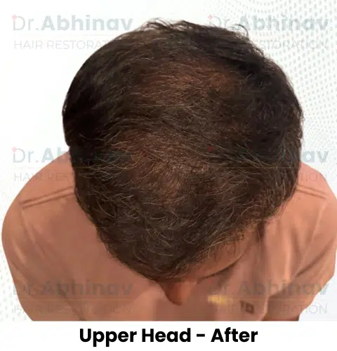 Shreyas Hair Transplant Upper Head View After - Patna