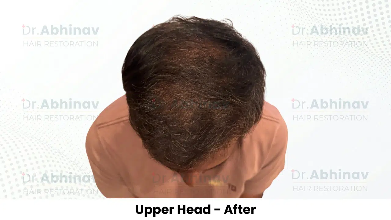 Shreyas Hair Transplant Upper Head View After - Patna