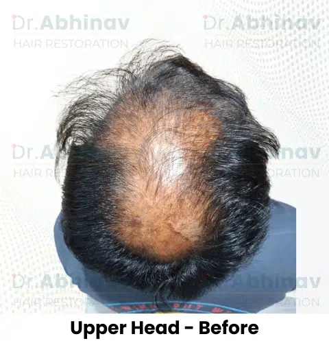 Shreyas Hair Transplant Upper Head View Before - Patna