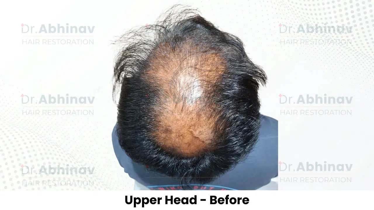 Shreyas Hair Transplant Upper Head View Before - Patna